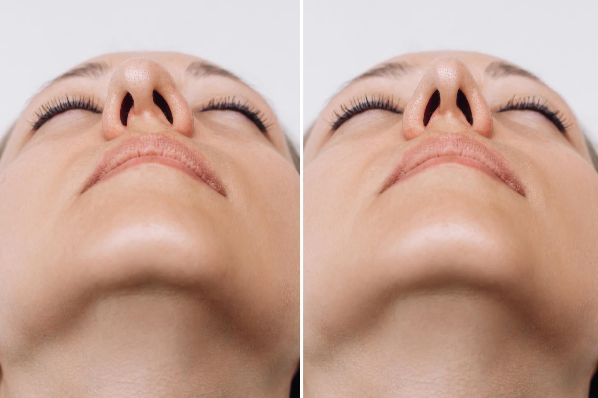 A close-up of woman's nose before and after rhinoplasty on gray