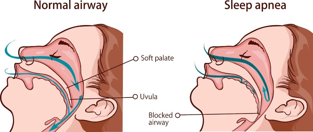 Chart depicting the different phases of sleep apnea, showing how it disrupts normal sleep cycles.