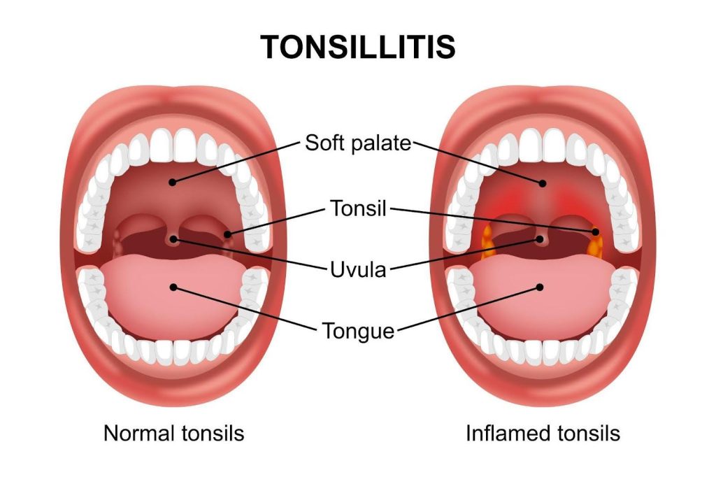 Detailed image showing a tongue and tonsils emphasizing their structure and position in the mouth