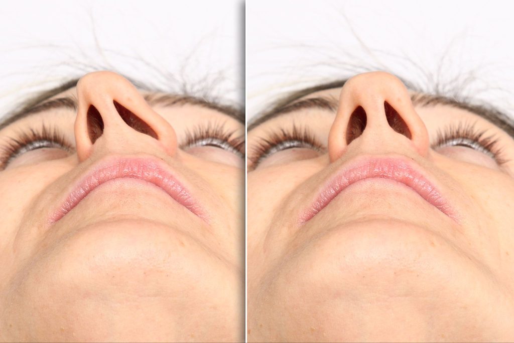 Before and after comparison of a rhinoplasty procedure, showing the correction of a deviated septum and improved nostril symmetry.