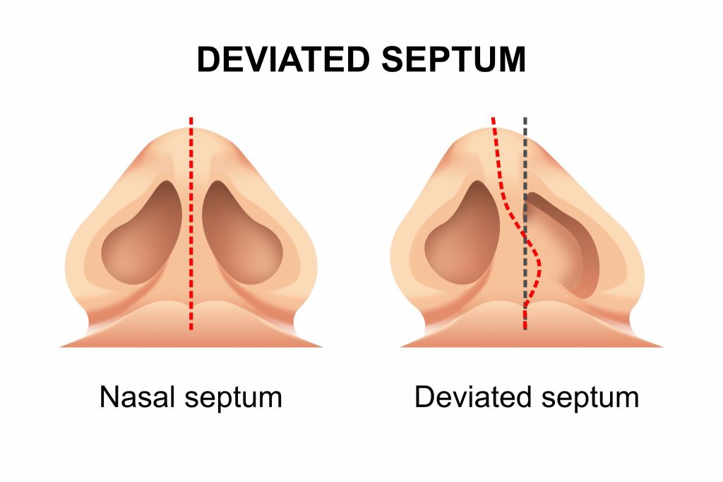 Medical illustration comparing a normal nasal septum with a deviated septum, showing how the misalignment can obstruct airflow in the nasal passage.