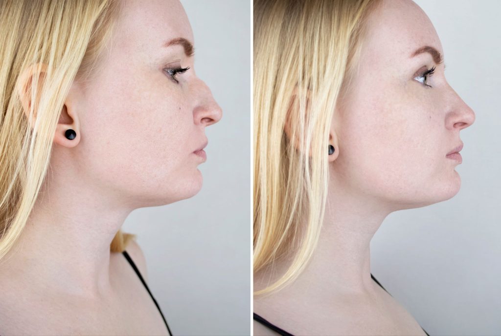Before-and-after side profile comparison of a woman's nose reshaping surgery.